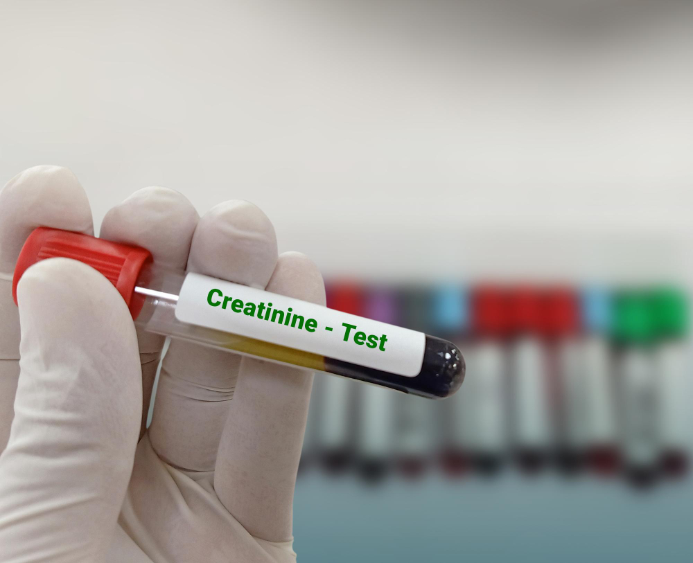 نسبة الكرياتين التي تؤدي إلى غسيل الكلى