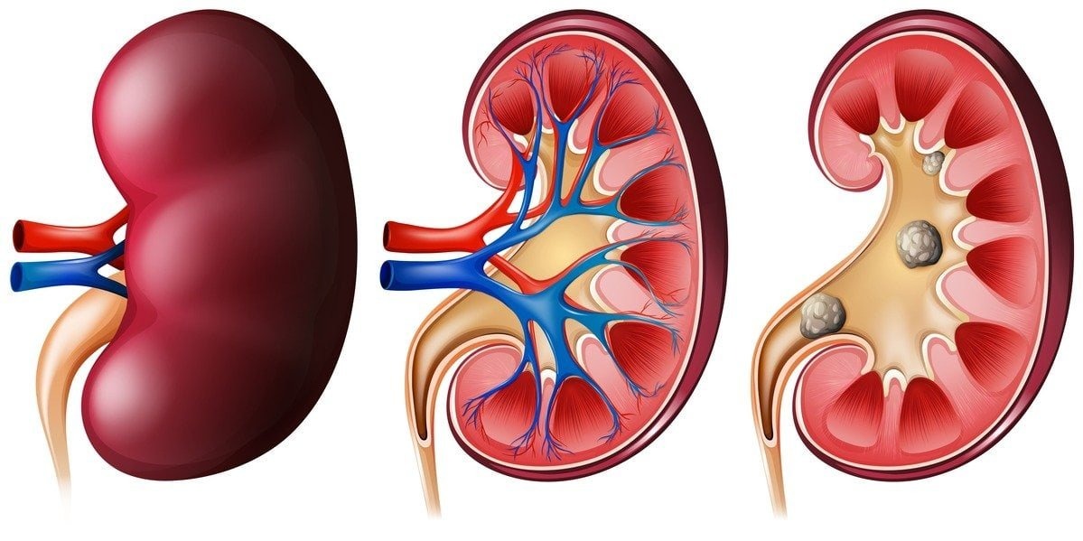 Living Kidney Donor Risks: Guide to Safety and Recovery